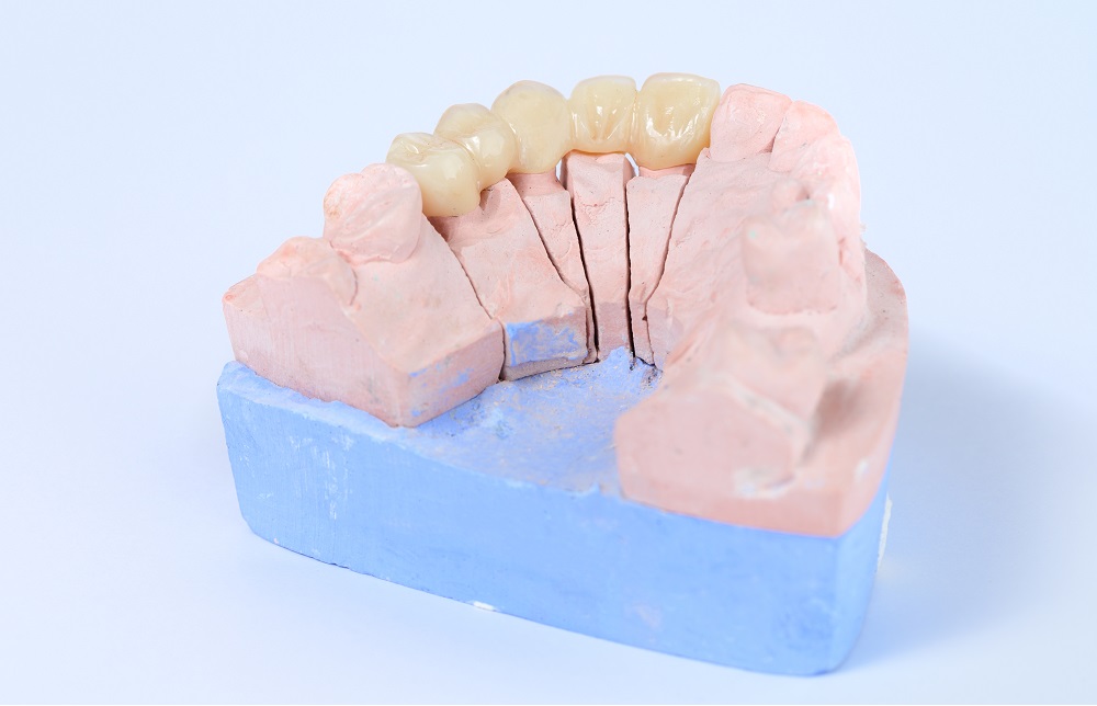 詰め物・被せ物