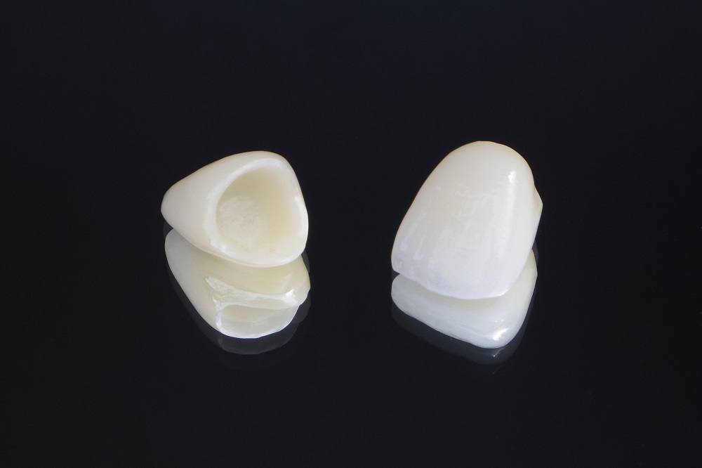 被せ物（クラウン）とは