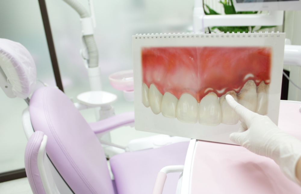 気付かない内に進行する歯周病